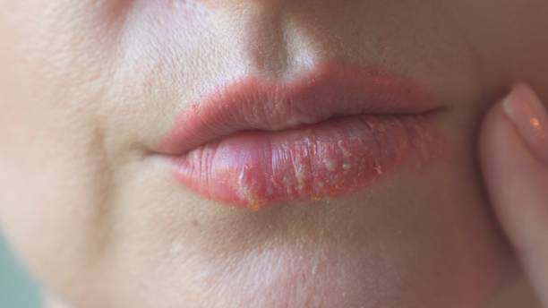 istock Herpes disease on women's lips. 1404736489