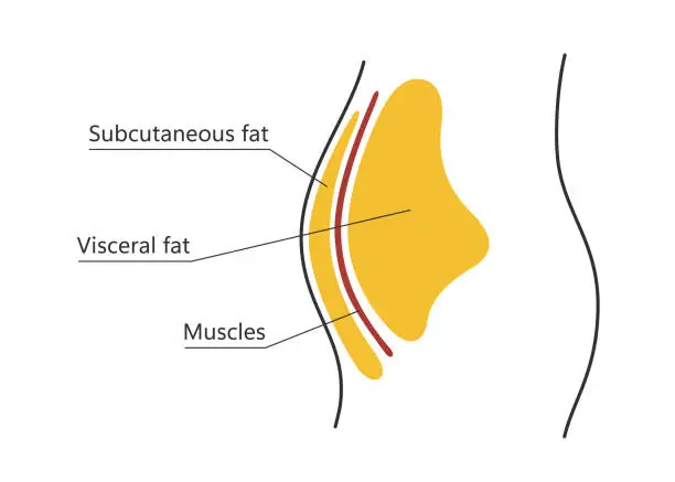 Vector illustration of Visceral and subcutaneous fat around waistline. Location of visceral fat in abdominal cavity. Types of human obesity. Medical scheme. Vector illustration isolated on white background