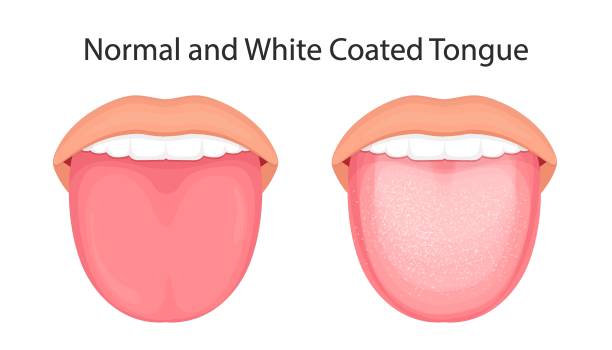 anatomia jamy ustnej. ilustracja wektorowa języka z białą powłoką. - virus unpleasant smell fungus animal stock illustrations
