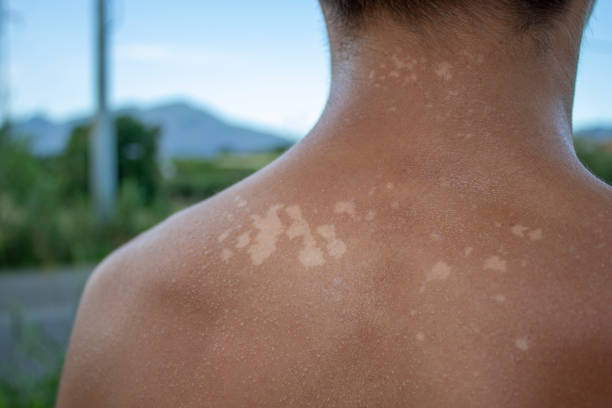 istock Skin care concept. Handsome guy got sunburn and got tan lines on his back. 1404862202