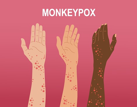 Monkey Pox hand collection. Illustration of Monkeypox symptoms