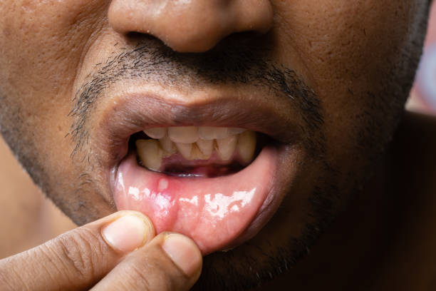 istock Painful mouth ulcer 1404985174
