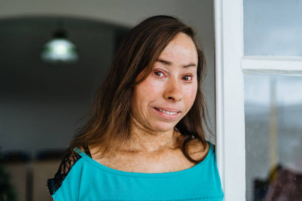 Woman with ichthyosis