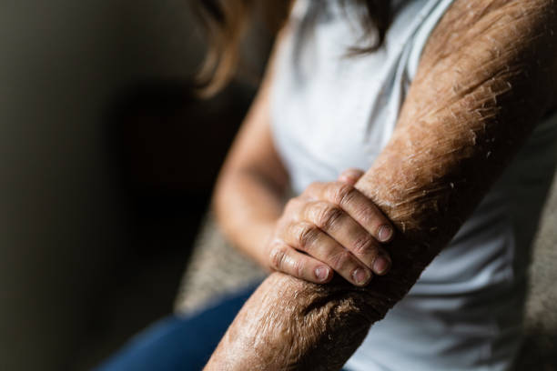 istock Woman with ichthyosis 1405077473