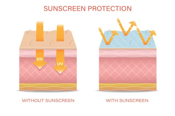 Vector illustration of Protection of the skin from ultraviolet radiation. The effect of sunlight on the skin with and without sunscreen.