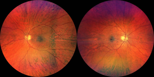 Photograph of the Fundus Oculi: left and right eye stock photo