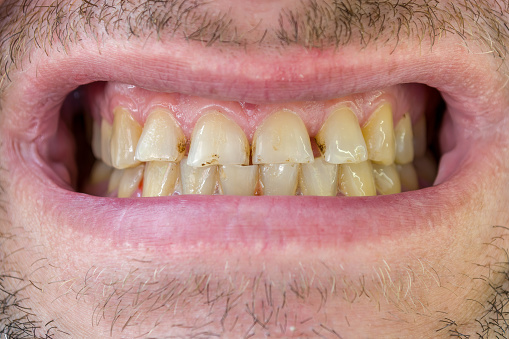 Ugly teeth of a man, crooked and dirty with plaque, close-up. Dentistry