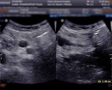 Ultrasound of urinary bladder  or KUB for  screening  renal and bladder disease.