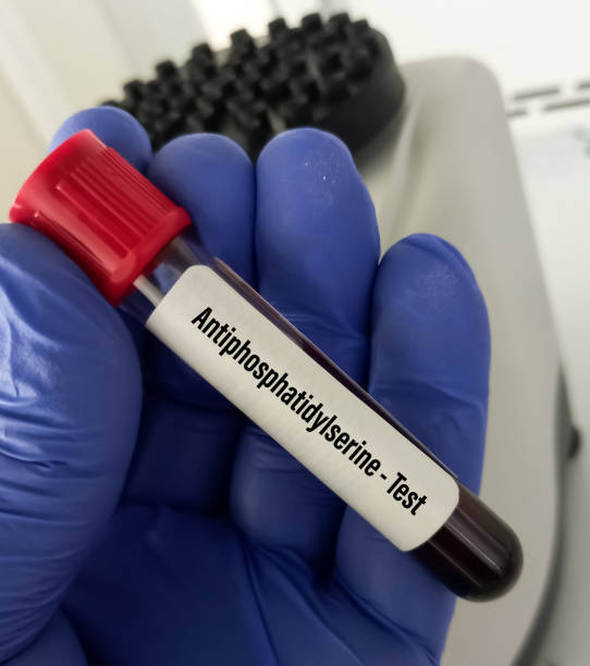 항 인산염 증후군을 진단하기 위해 항 포스파티딜 세린 테스트를위한 혈액 샘플. - antithrombin 뉴스 사진 이미지