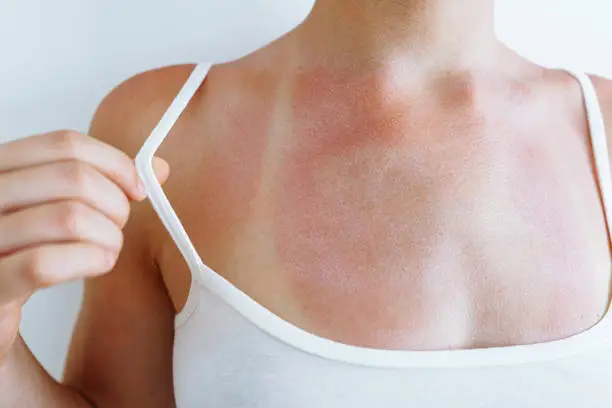 woman has sore skin, redness and blisters, burst blood vessels, effects of sunburn.