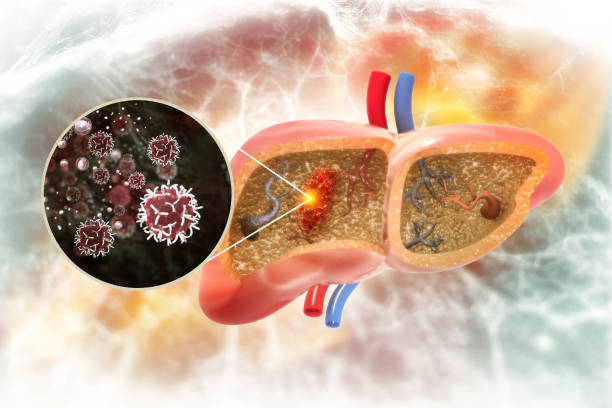 câncer de fígado ou tumor hepático, carcinoma hepatocelular (hcc), causas, sintomas, tratamentos, ilustração 3d - yellowing - fotografias e filmes do acervo