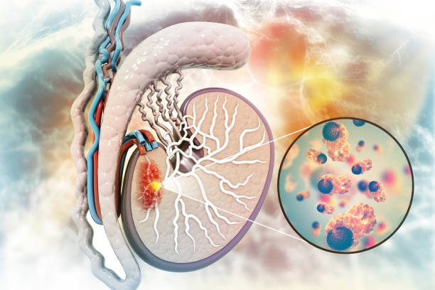 istock Testicular cancer, cross section, 3d illustration 1405592463