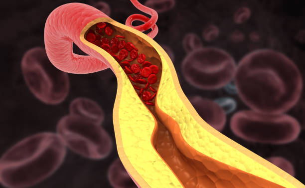 istock Cholesterol plaque in artery.3d illustration 1405594025