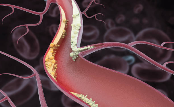 Understanding Atherosclerosis and Its Effects on Health calcium plaque in arteries causing atherosclerosis