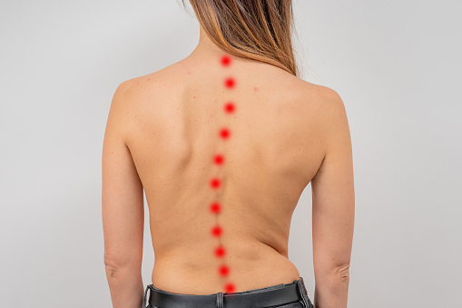 Mujer con escoliosis de la columna vertebral. Espalda curvada de la mujer con piel de acné. photo