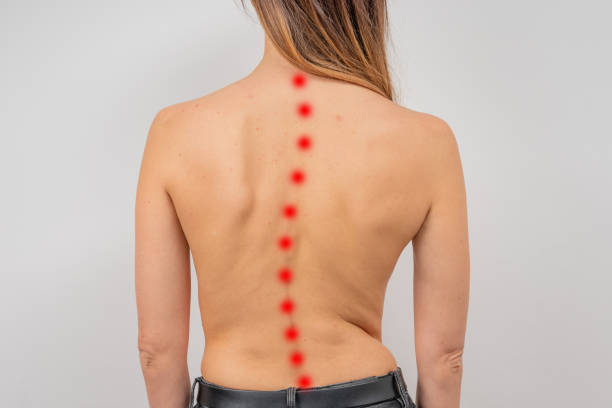 脊柱の脊柱側弯症を有する女性。にきびの皮膚を持つ湾曲した女性の背中。 - scoliosis ストックフォトと画像