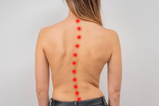 Woman with scoliosis of the spine. Curved woman's back with acne skin. Woman with scoliosis of the spine. Curved woman's back with acne skin. Pelvis stock pictures, royalty-free photos & images