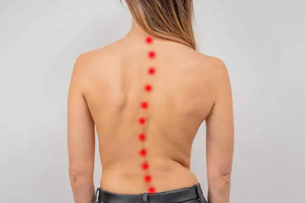 Photo of Woman with scoliosis of the spine. Curved woman's back with acne skin.