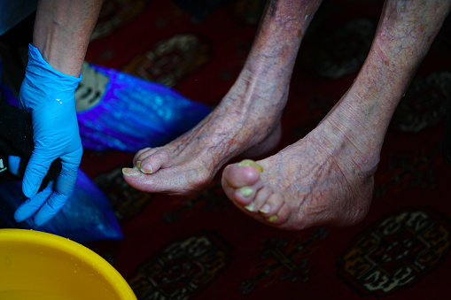 Feet of a woman ready for pedicure washing and nail cleaning. On photo are very old legs, hand with gloves of helping lady and water container.
