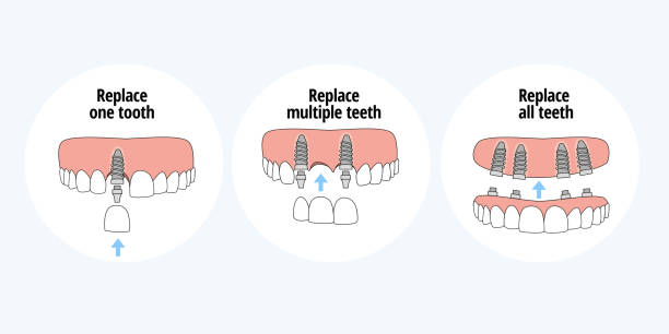 illustrazioni stock, clip art, cartoni animati e icone di tendenza di tipi di impianti dentali per sostituire un dente, più denti e tutti i denti - impianto dentale