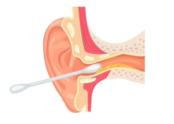 ilustrações de stock, clip art, desenhos animados e ícones de illustration of cleaning the ear canal with a cotton swab. ear section with earwax. incorrect use of a cotton swab. - eustachian tube