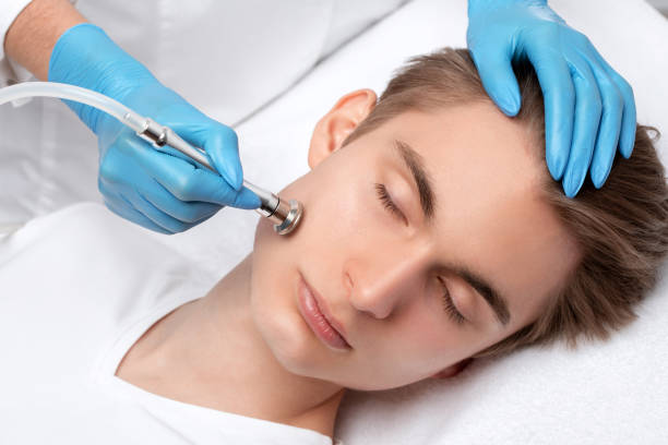 un cosmetólogo está haciendo el procedimiento microdermabrasión de la piel facial en un salón de belleza. cosmetología para hombres y cuidado profesional de la piel. - dermatology dermabrasion surgery medical fotografías e imágenes de stock