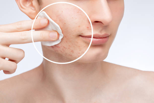 istock A young guy with problem skin on his face. Photos before and after acne treatment.Cleansing the skin from impurities. 1405867617