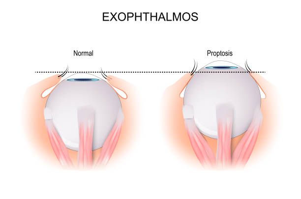 Exophthalmos. comparison and difference Exophthalmos is a bulging of the eye anteriorly out of the orbit. comparison and difference between normal eyeball and disorder that caused by Grave's Disease. vector illustration thyroid disease stock illustrations