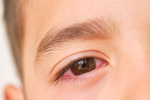 eye of a caucasian boy reddened with conjunctivitis caused by allergy