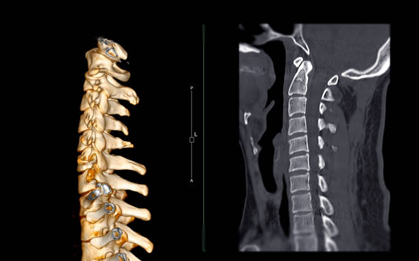 istock CT SCAN of Cervical Spine ( C-spine ). 1405946811