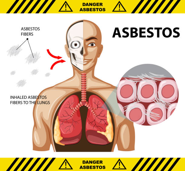 Diagram showing asbestosis in lungs Diagram showing asbestosis in lungs illustration clip art of a diagram of human lungs stock illustrations