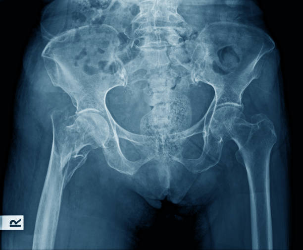 x ray image of pelvic bone stock photo