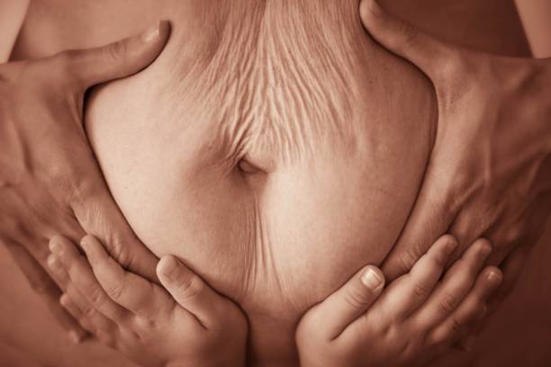 A mother with a postpartum belly and stretch marks on her stomach. Motherhood and maternity after birth. stock photo