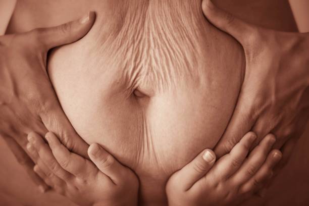 tummy tuck