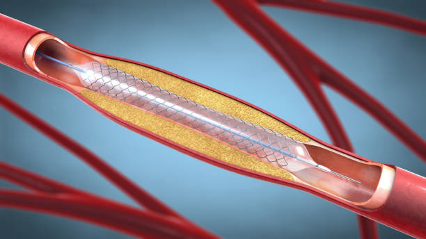 implantation d’endoprothèses pour soutenir la circulation sanguine dans les vaisseaux sanguins - illustration 3d - opération du coeur photos et images de collection