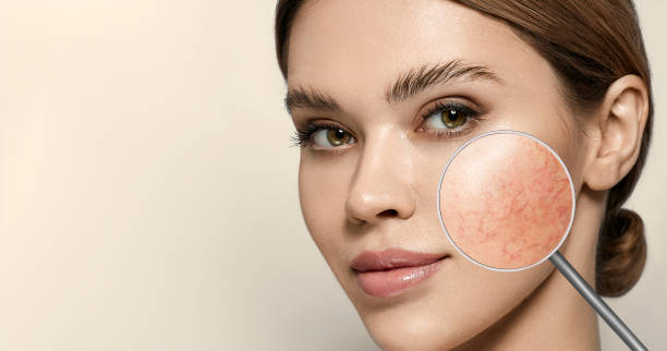 Magnifying glass showing couperose on face skin. Woman showing problems couperose-prone sensitive skin stock photo