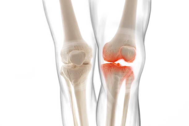 istock Medically accurate representation of an arthritic knee joint, knee meniscus, human leg 1406229241