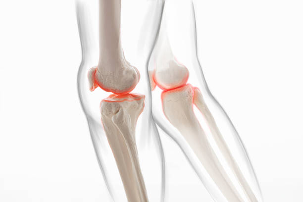 istock Medically accurate representation of an arthritic knee joint, knee meniscus, human leg 1406229250