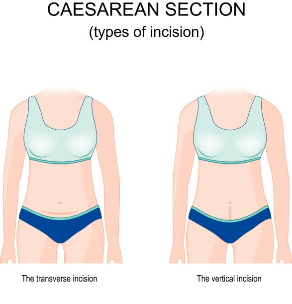 ilustrações de stock, clip art, desenhos animados e ícones de caesarean section. types of incision. - cesarean