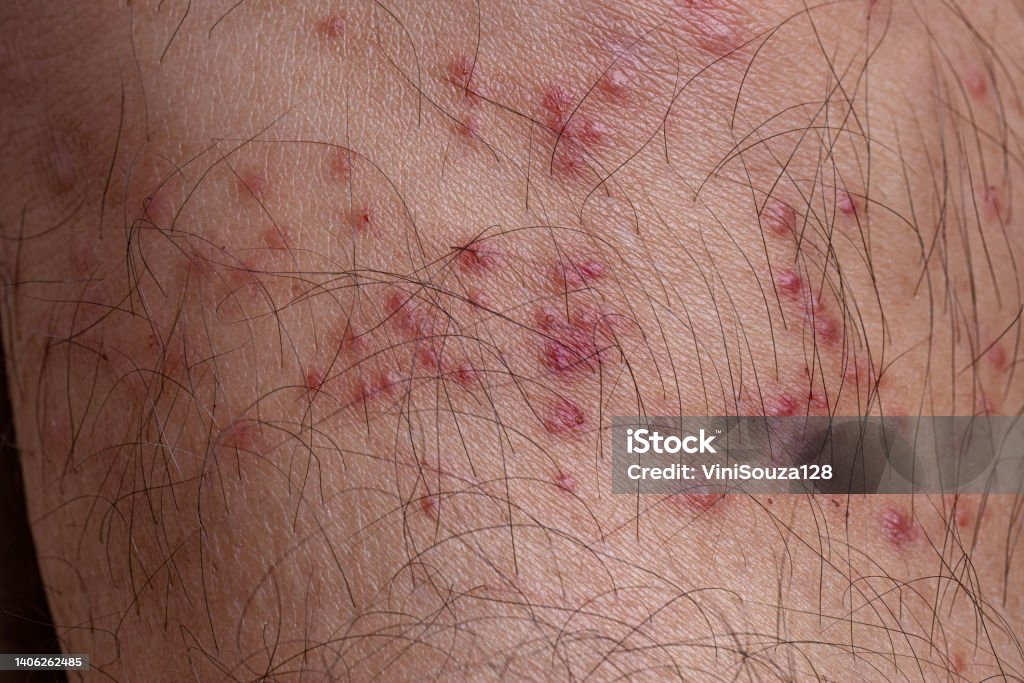 Allergic Reactions To Tick Bites Stock Photo Download Image Now