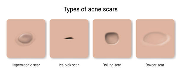Types of acne scars. Facial skin problems. Hypertrophic scar, Ice pick, Rolling and Boxcar. Vector for advertising about beauty and medical treatment. Types of acne scars. Facial skin problems. Hypertrophic scar, Ice pick, Rolling and Boxcar. Vector for advertising about beauty and medical treatment. scar stock illustrations