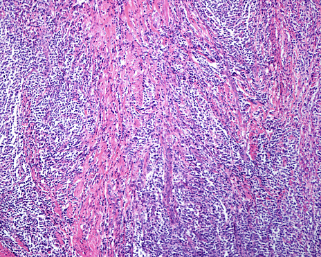Low magnification micrograph showing a reticulosarcoma, a malignant lymphoma, infiltrating the muscular layer of the stomach.