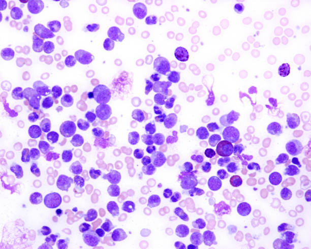 istock Blood smear. Chronic myeloid leukaemia 1406339181