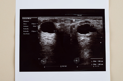 Ultrasound image of a breast