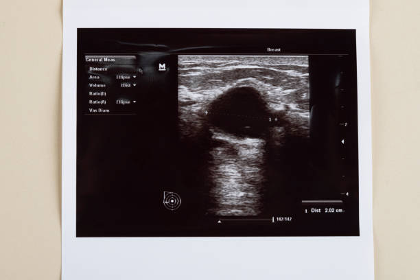 Ultrasound image of a breast