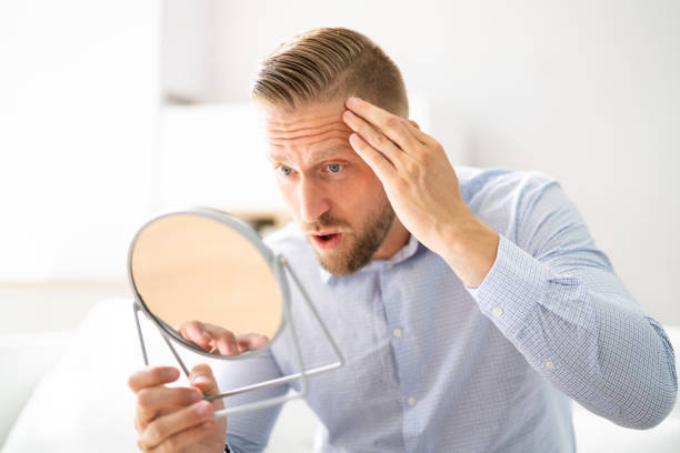 istock Alopecia Man Hair Loss 1406458342