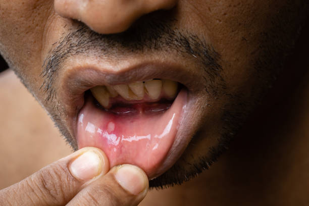 istock Painful mouth ulcer 1406476768