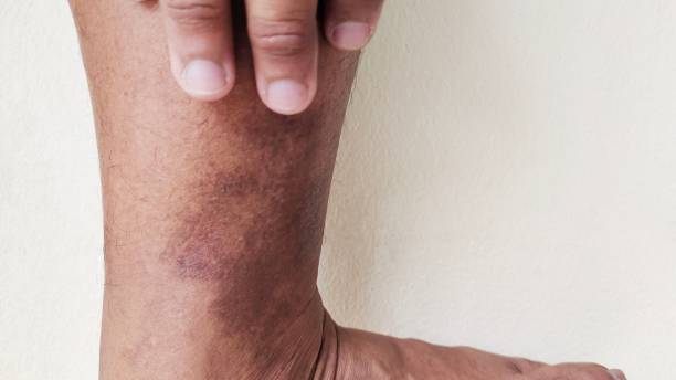 ulcere alle gambe e infezioni della pelle in pazienti di sesso maschile. - wound sunburned scar physical injury foto e immagini stock