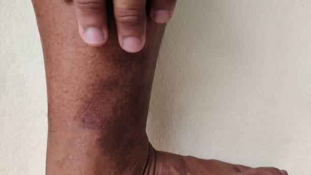 ulcere alle gambe e infezioni della pelle del paziente - wound sunburned scar physical injury foto e immagini stock