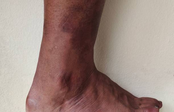 ulcere alle gambe e infezioni della pelle di pazienti di sesso maschile - wound sunburned scar physical injury foto e immagini stock